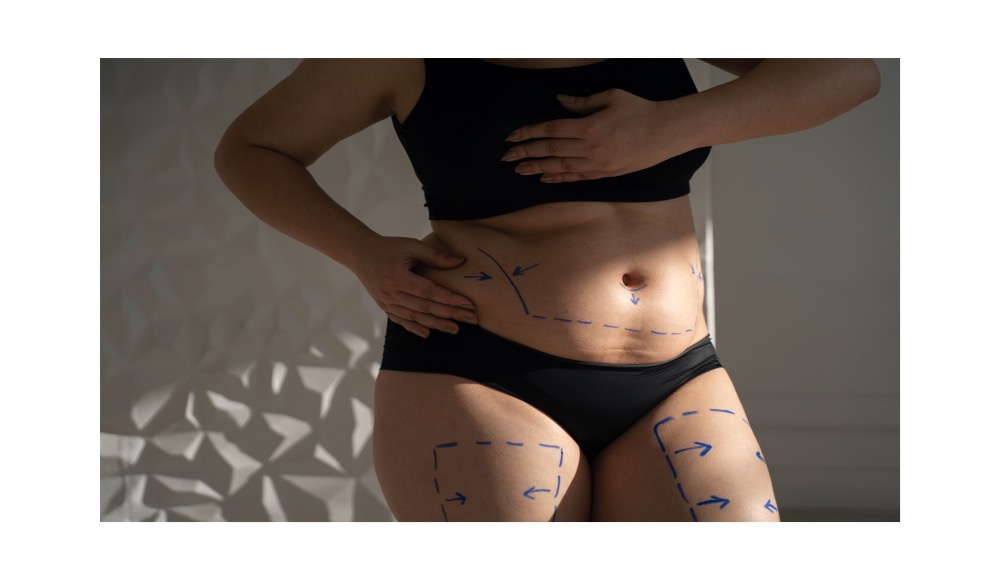 Skin marking before liposuction