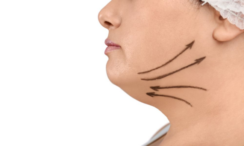 Comprehensive Guide to Facelift and Neck Lift Surgery for Facial Rejuvenation